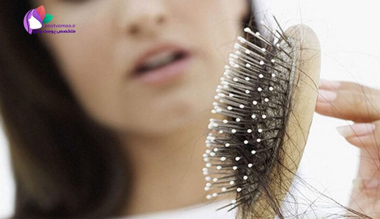 برای جلوگیری از ریزش مو سر چی بخوریم؟